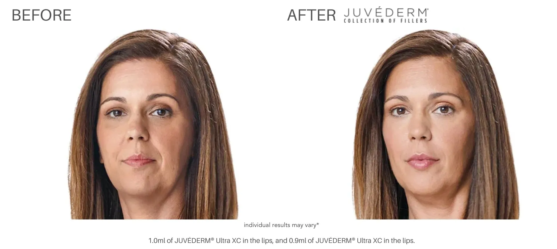 juvederm lip filler